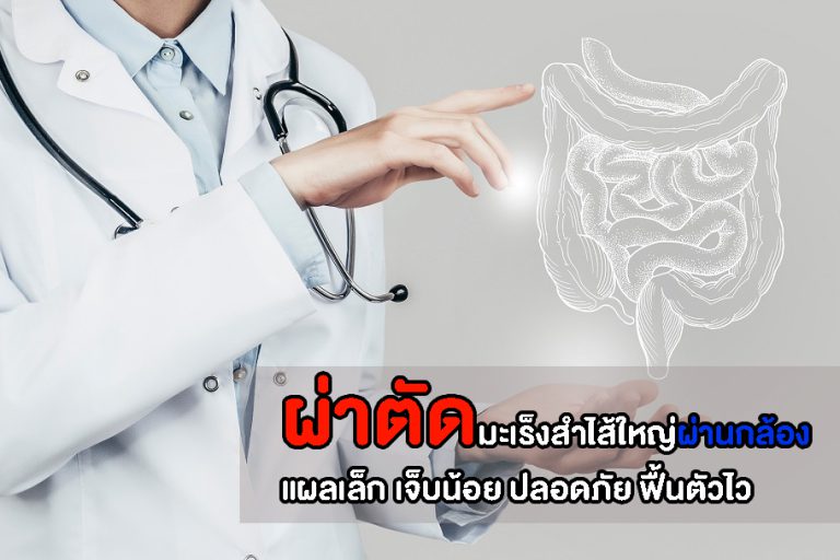 ผ่าตัดมะเร็งสำไส้ใหญ่ผ่านกล้อง แผลเล็ก เจ็บน้อย ปลอดภัย ฟื้นตัวไว